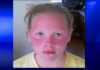 Severe Sunburn Blamed on School's Sunscreen Ban